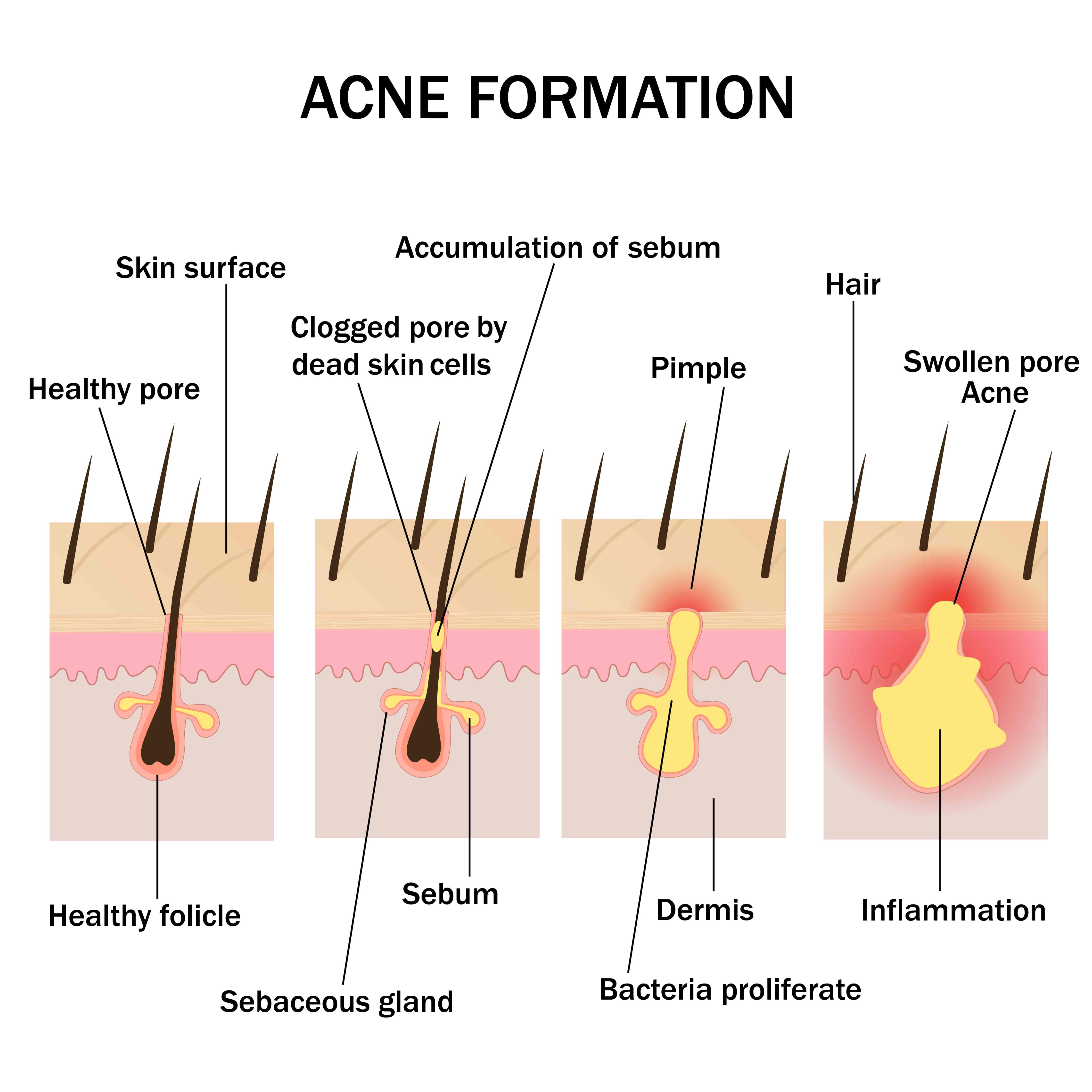 Got Acne? Learn How an Infrared Sauna Can Help Maintain Your Skin - JNH ...